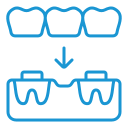dental bridge