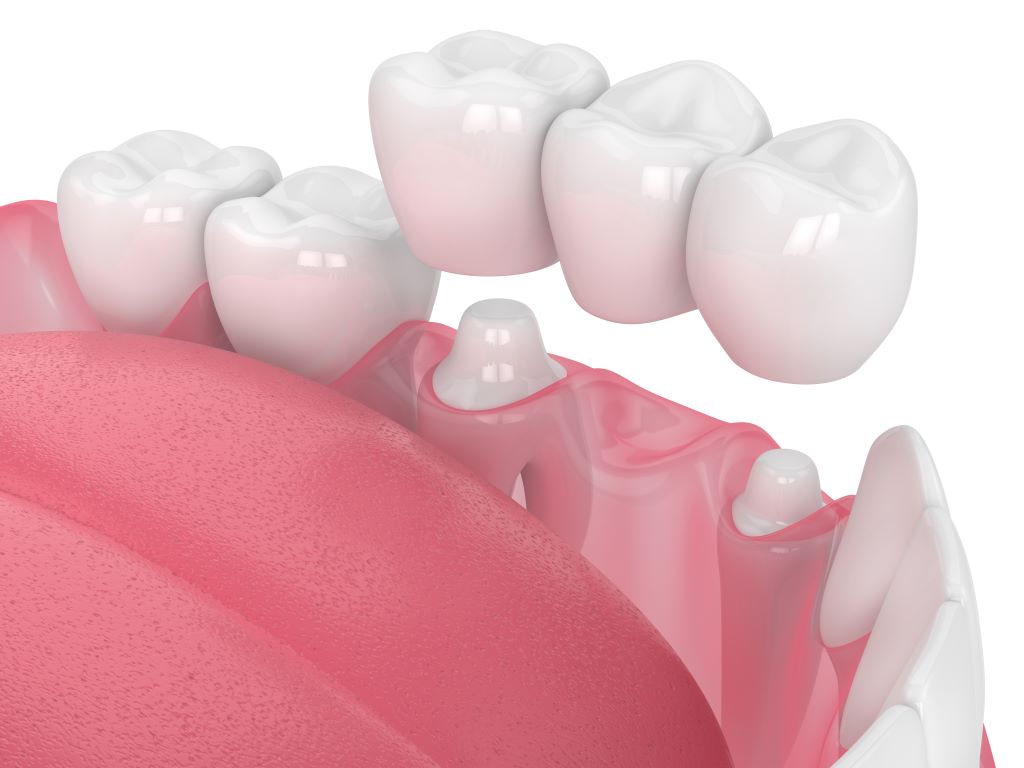 dental bridges in sw edmonton
