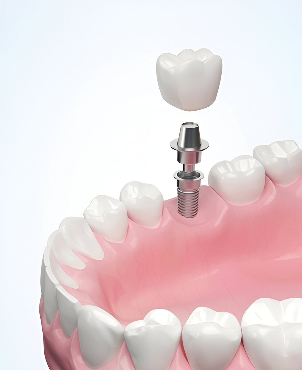 implant restorations in sw edmonton