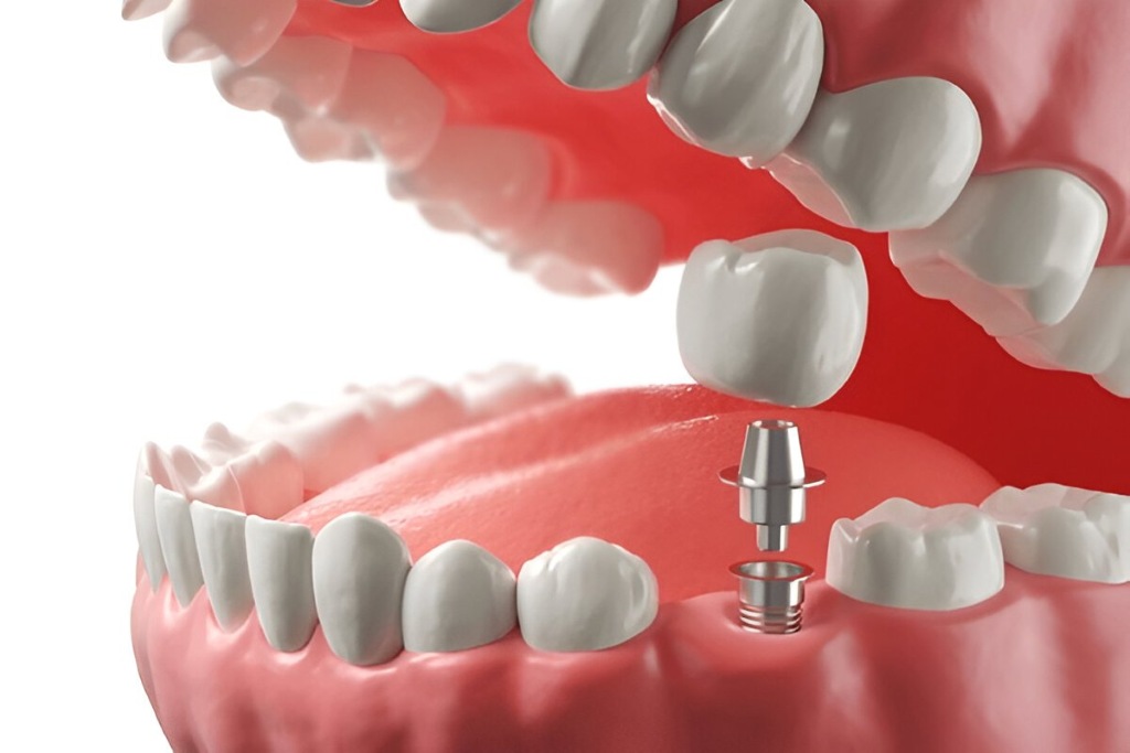 implant restorations near you