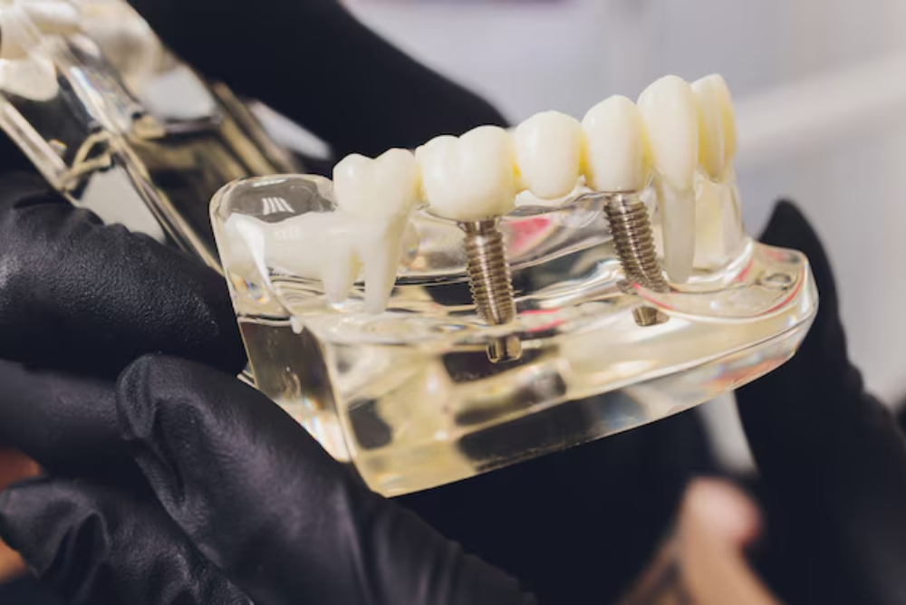 Looking for implant restoration in SW Edmonton? We offer expert implant restoration near you to restore function and confidence. Book a consultation today.