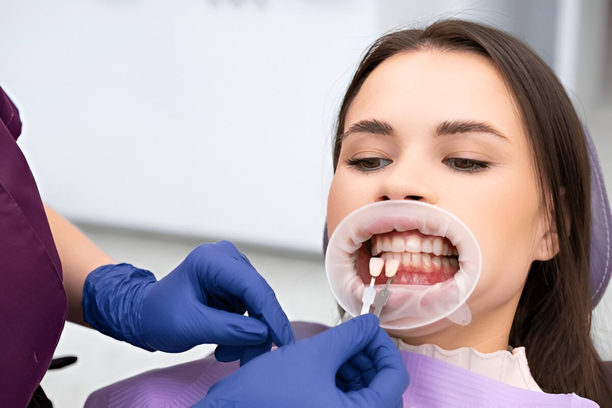 dental veneers near you in sw edmonton