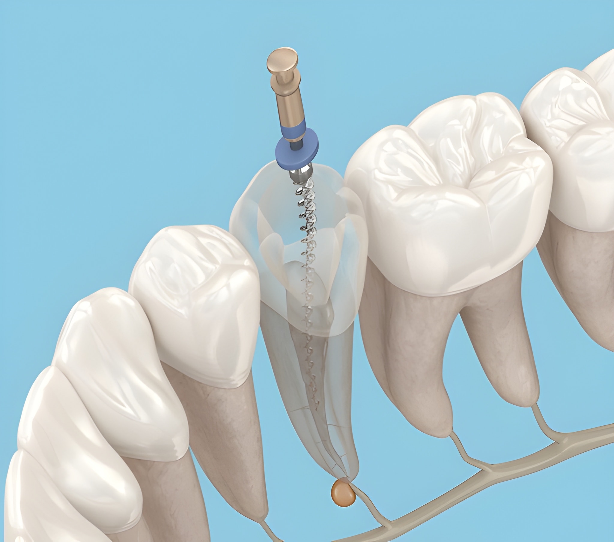 root canal therapy near you