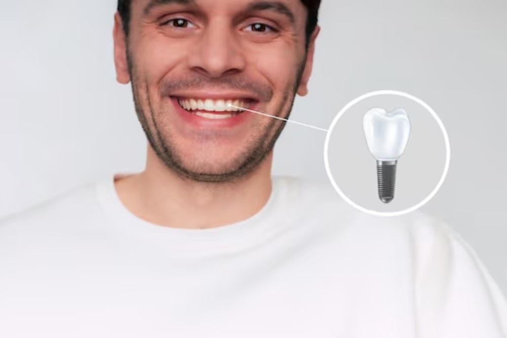 Can Dental Implants Replace Multiple Teeth?